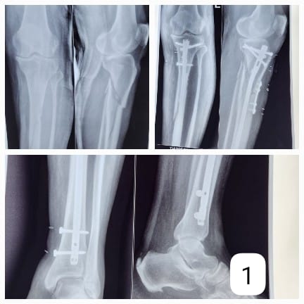 M.C. Orthopaedic Arthroscopy & Joint Replacement Center Tumkur